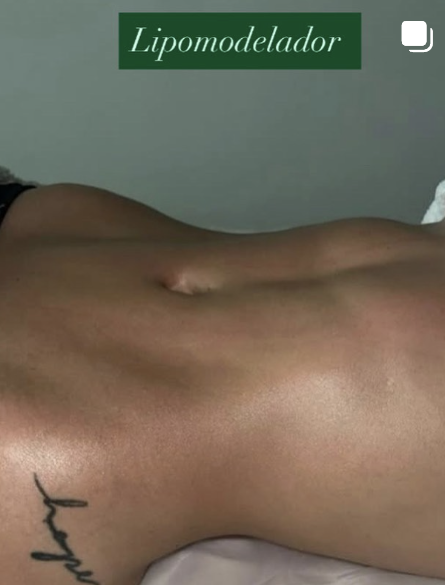 Resultado Lipomodelador